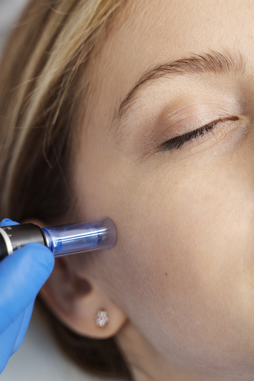 Microneedling-Stuttgart